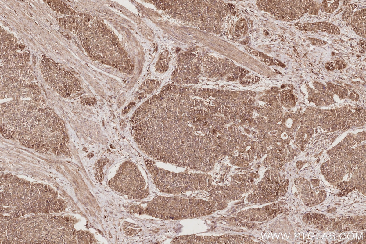 IHC staining of human stomach cancer using 21748-1-AP Immunohistochemistry (IHC) staining of human stomach cancer tissue using APC1 Polyclonal antibody (21748-1-AP)