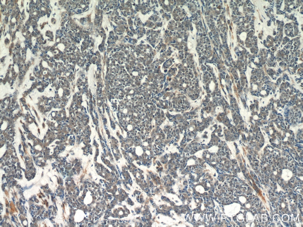 Immunohistochemistry (IHC) staining of human cervical cancer tissue using APC1 Polyclonal antibody (21748-1-AP)