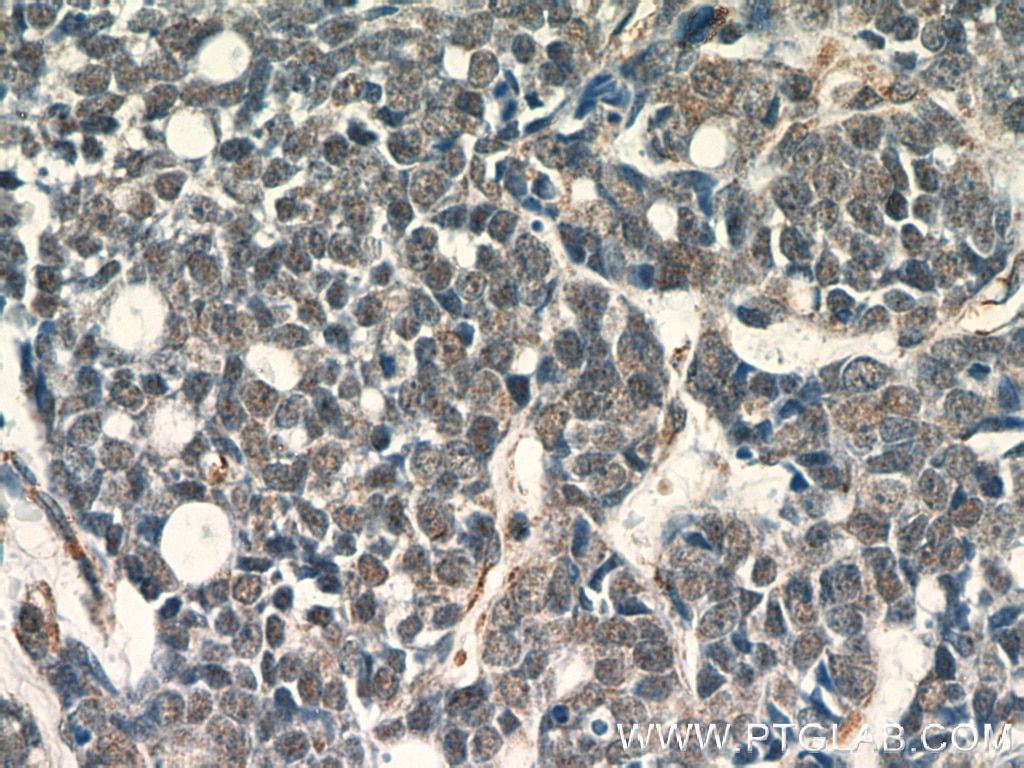Immunohistochemistry (IHC) staining of human cervical cancer tissue using APC1 Polyclonal antibody (21748-1-AP)