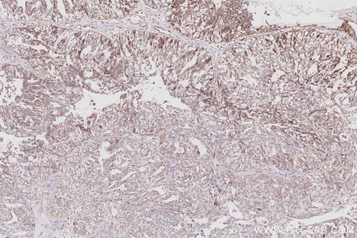 IHC staining of human ovary cancer using 15788-1-AP Immunohistochemistry (IHC) staining of human ovary cancer tissue using ANAPC10 Polyclonal antibody (15788-1-AP)
