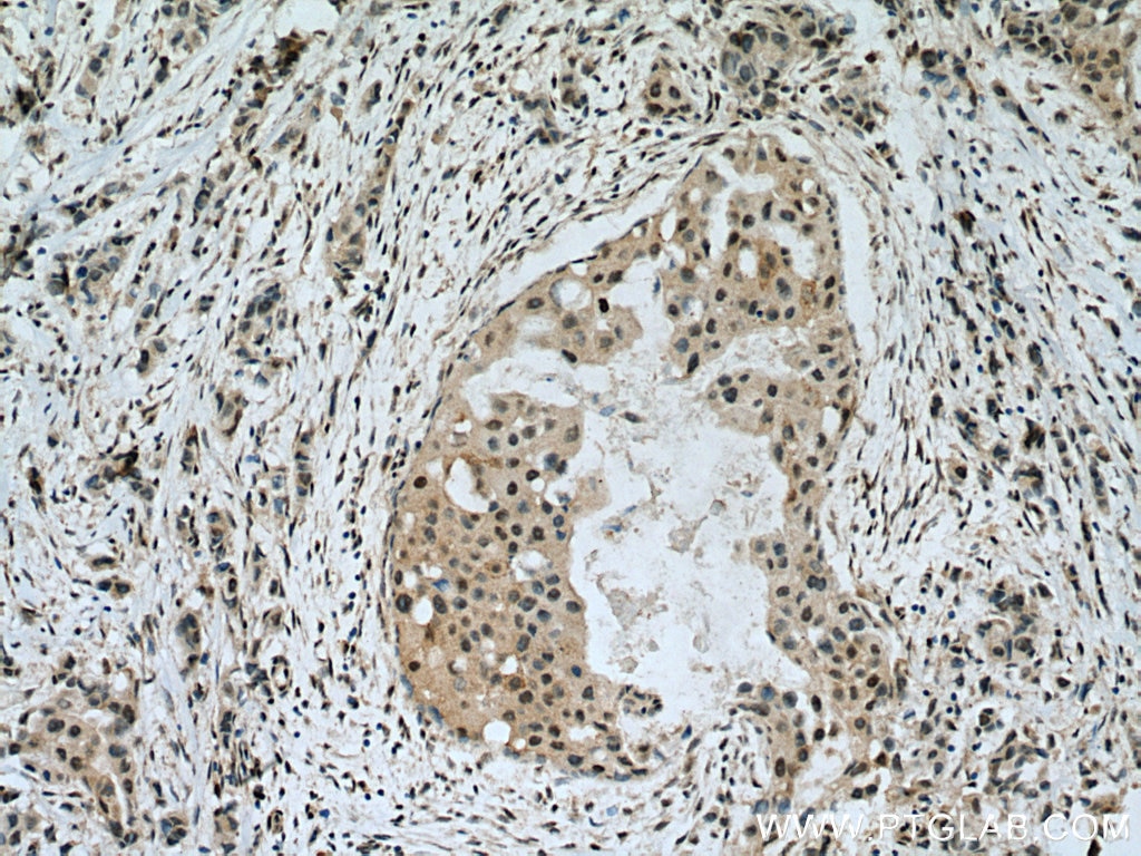 Immunohistochemistry (IHC) staining of human breast cancer tissue using APC2 Polyclonal antibody (13559-1-AP)