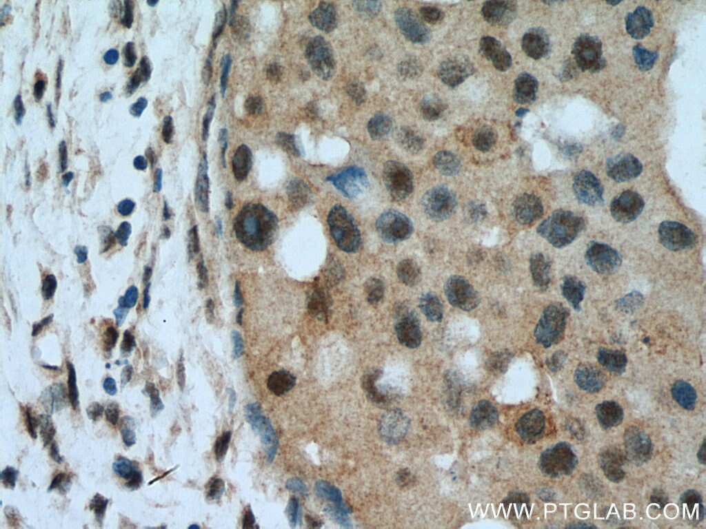 Immunohistochemistry (IHC) staining of human breast cancer tissue using APC2 Polyclonal antibody (13559-1-AP)