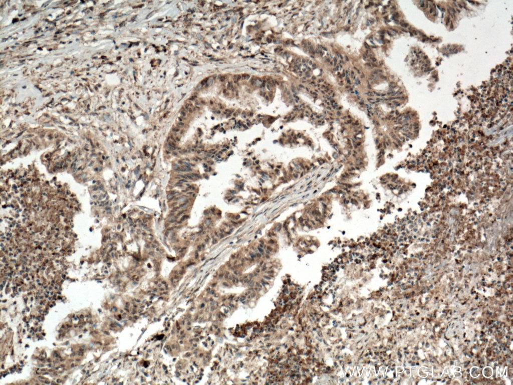 Immunohistochemistry (IHC) staining of human pancreas cancer tissue using ANAPC5 Polyclonal antibody (14926-1-AP)