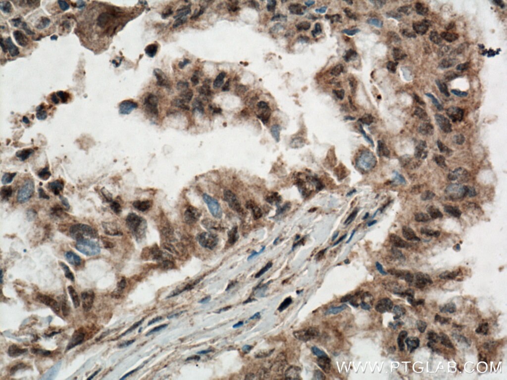 Immunohistochemistry (IHC) staining of human pancreas cancer tissue using ANAPC5 Polyclonal antibody (14926-1-AP)