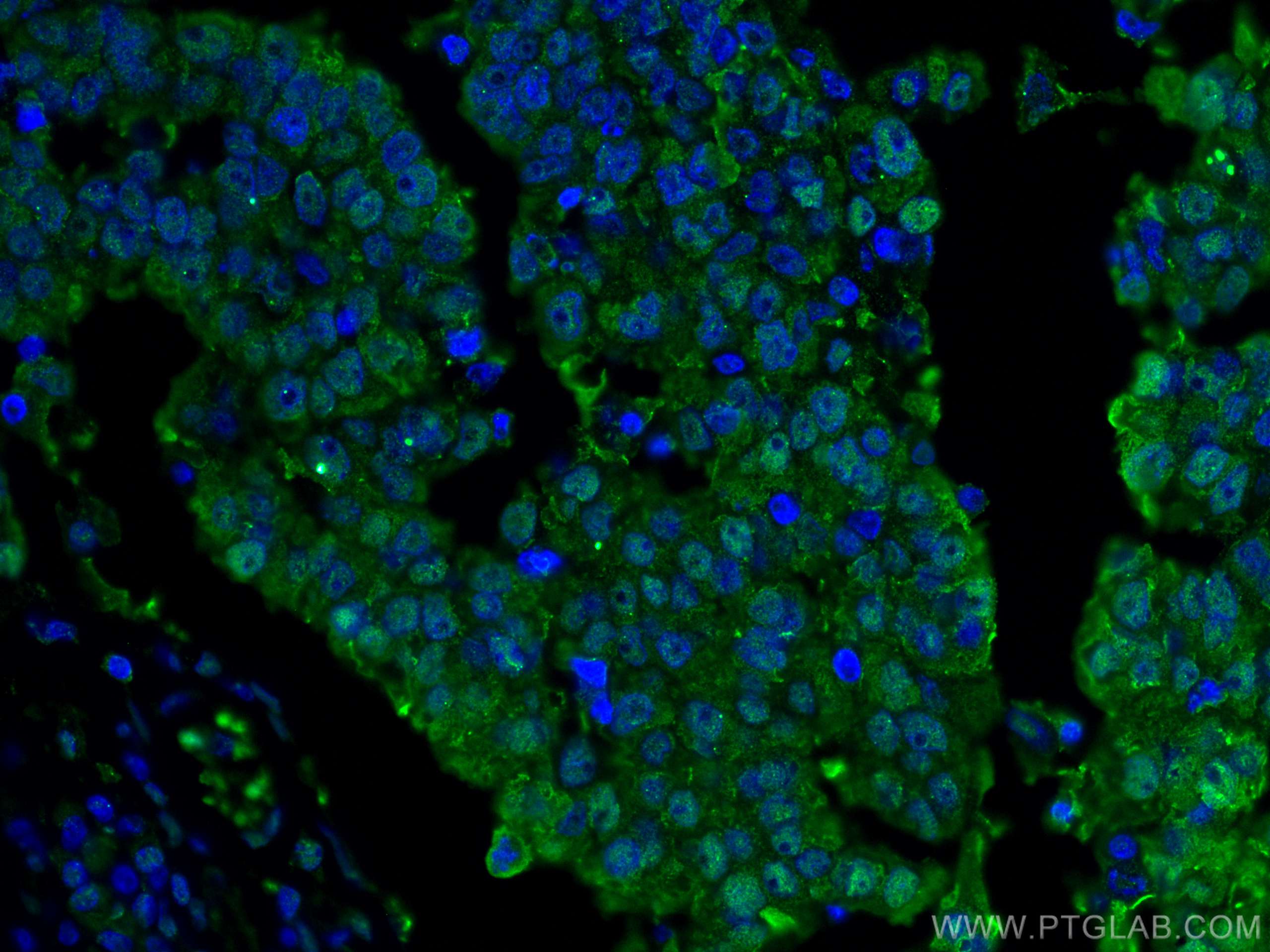 Immunofluorescence (IF) / fluorescent staining of human breast cancer tissue using ANAPC5 Monoclonal antibody (67348-1-Ig)