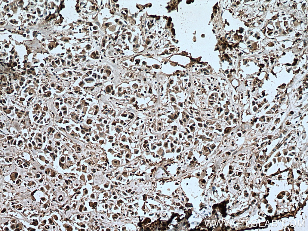 Immunohistochemistry (IHC) staining of human breast cancer tissue using ANAPC5 Monoclonal antibody (67348-1-Ig)