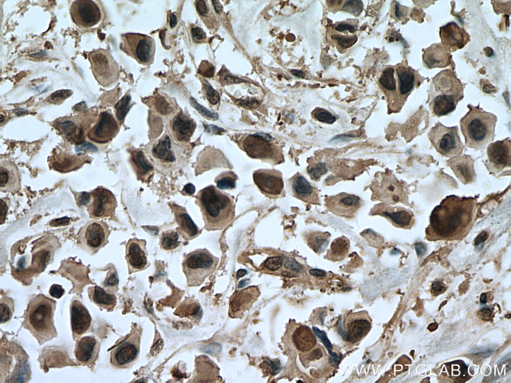 Immunohistochemistry (IHC) staining of human breast cancer tissue using ANAPC5 Monoclonal antibody (67348-1-Ig)