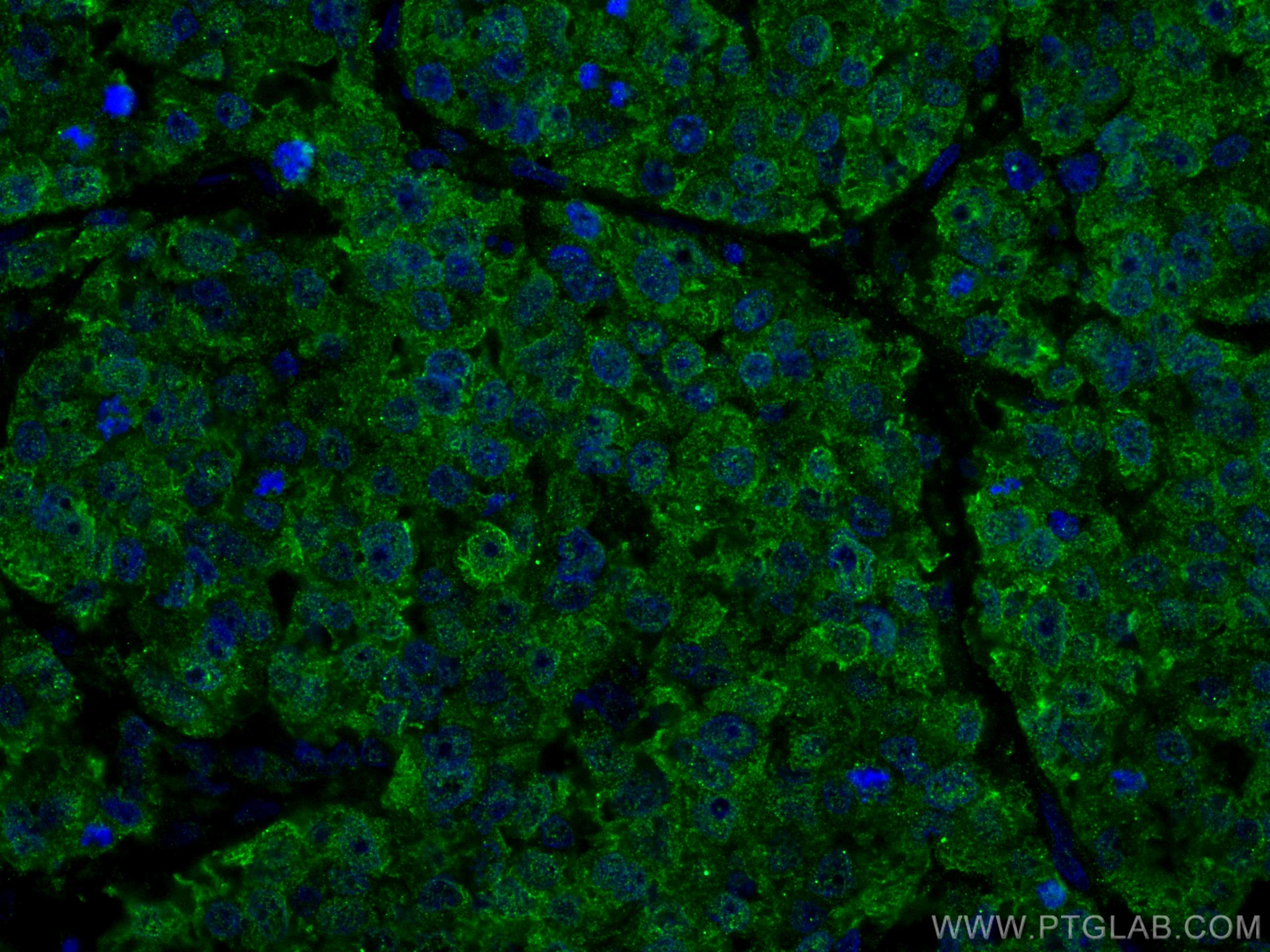 Immunofluorescence (IF) / fluorescent staining of human breast cancer tissue using CoraLite® Plus 488-conjugated ANAPC5 Monoclonal an (CL488-67348)