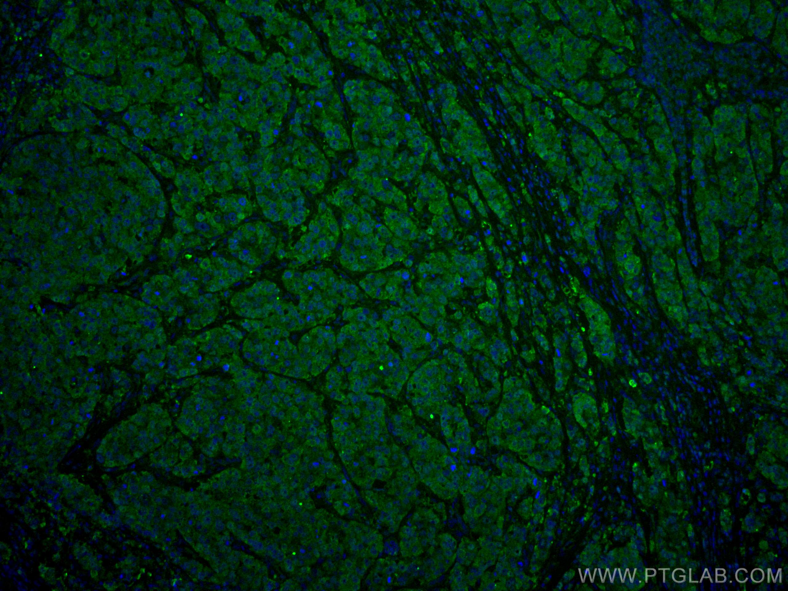 Immunofluorescence (IF) / fluorescent staining of human breast cancer tissue using CoraLite® Plus 488-conjugated ANAPC5 Monoclonal an (CL488-67348)