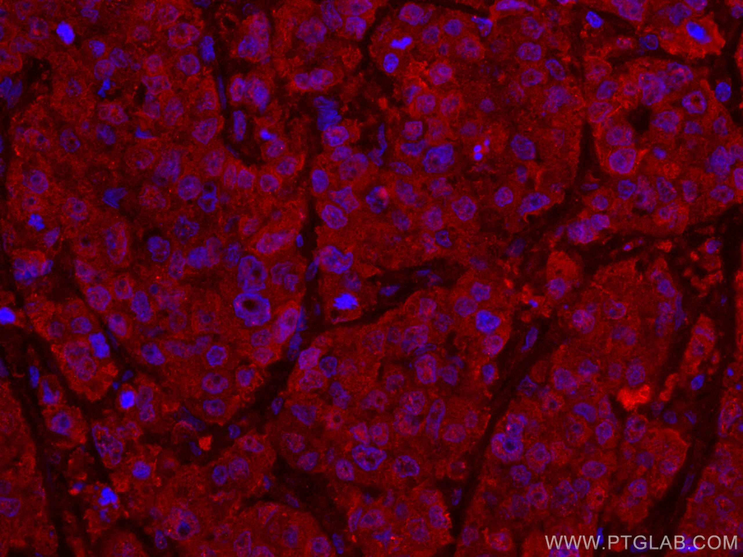 Immunofluorescence (IF) / fluorescent staining of human breast cancer tissue using CoraLite®594-conjugated ANAPC5 Monoclonal antibody (CL594-67348)