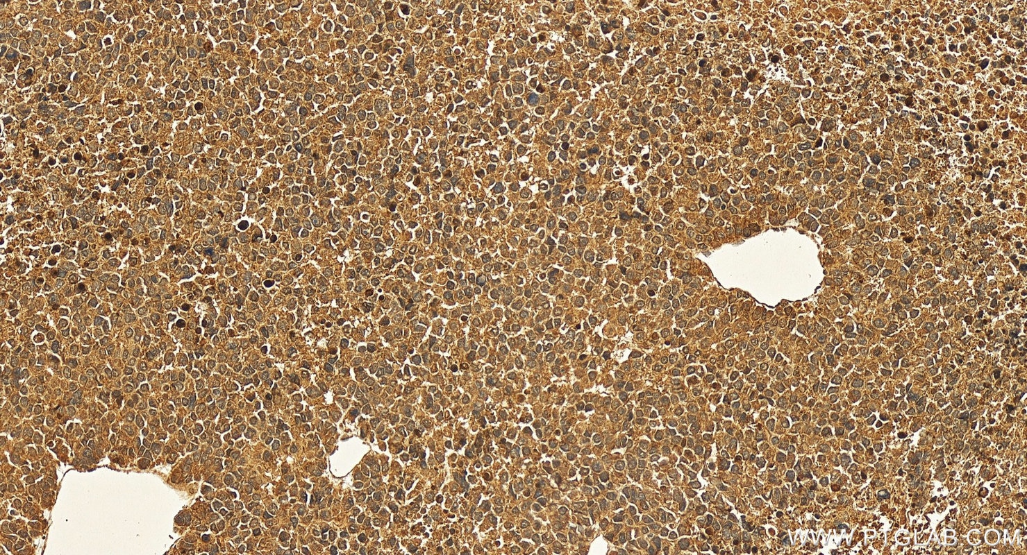Immunohistochemistry (IHC) staining of human Hepatocellular carcinoma using Angiogenin Polyclonal antibody (18302-1-AP)