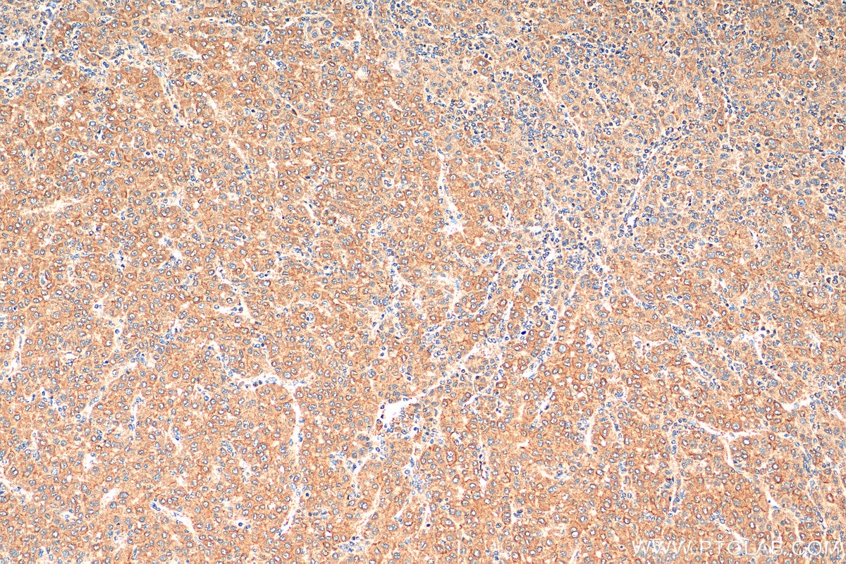 Immunohistochemistry (IHC) staining of human liver cancer tissue using Angiopoietin 2 Polyclonal antibody (24613-1-AP)