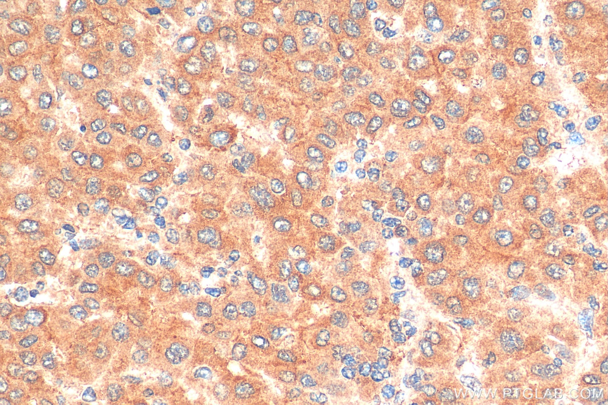 Immunohistochemistry (IHC) staining of human liver cancer tissue using Angiopoietin 2 Polyclonal antibody (24613-1-AP)