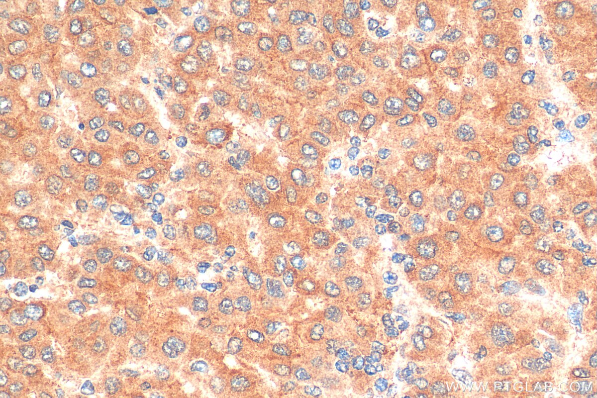 Immunohistochemistry (IHC) staining of human liver cancer tissue using Angiopoietin 2 Polyclonal antibody (24613-1-AP)