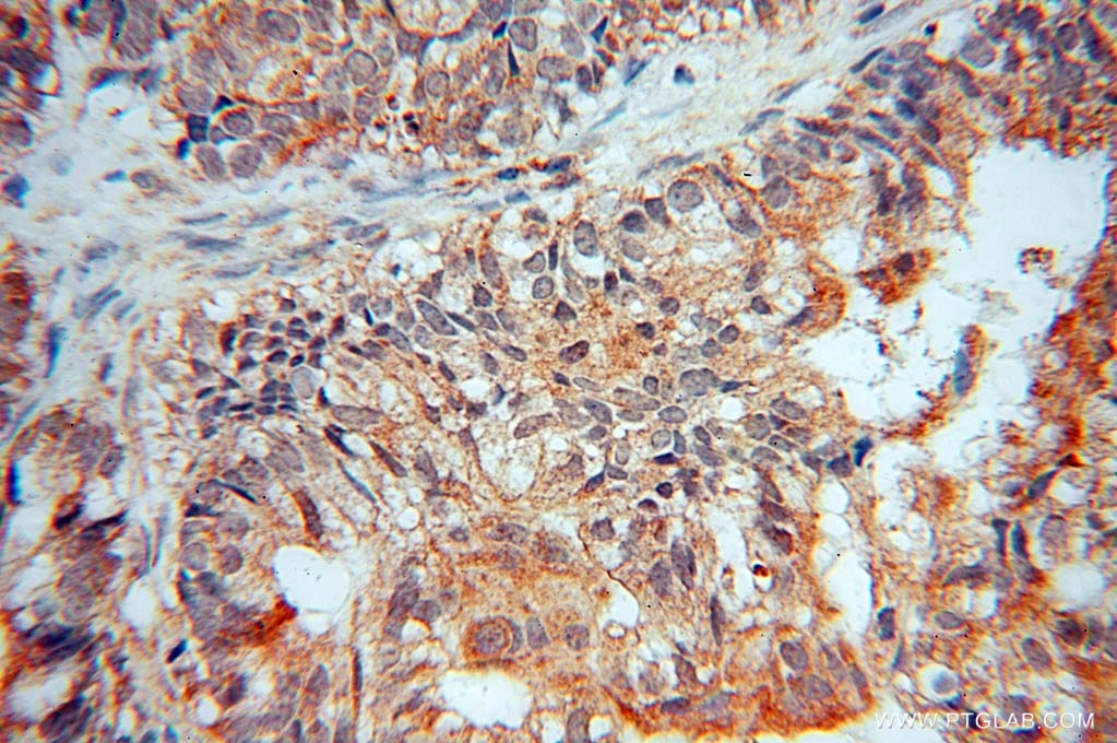 Immunohistochemistry (IHC) staining of human ovary tumor tissue using ANGPTL1 Polyclonal antibody (14709-1-AP)