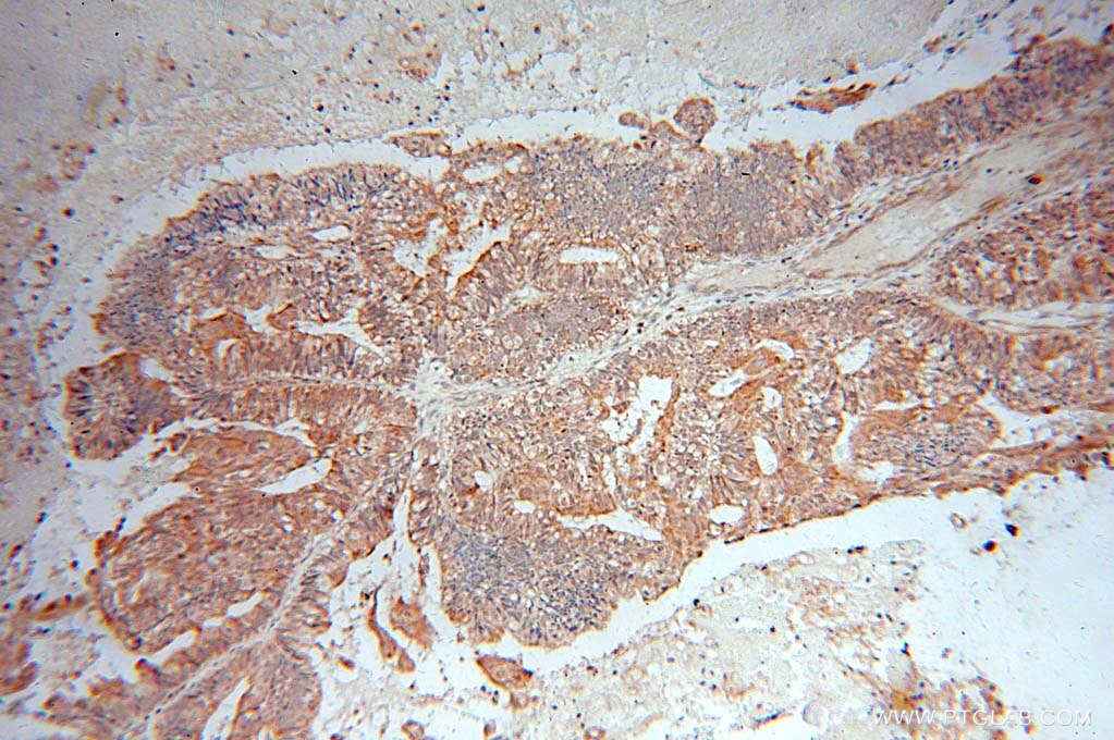 Immunohistochemistry (IHC) staining of human ovary tumor tissue using ANGPTL1 Polyclonal antibody (14709-1-AP)