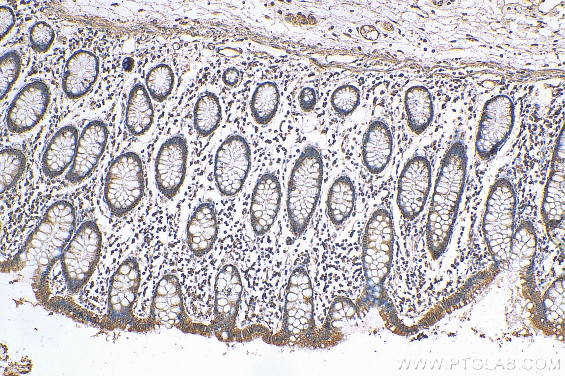 IHC staining of human colon cancer using 12316-1-AP