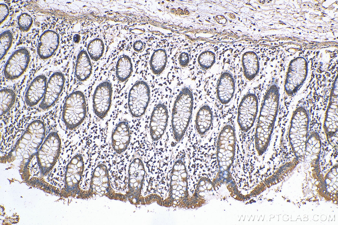 Immunohistochemistry (IHC) staining of human colon cancer tissue using ANGPTL2 Polyclonal antibody (12316-1-AP)