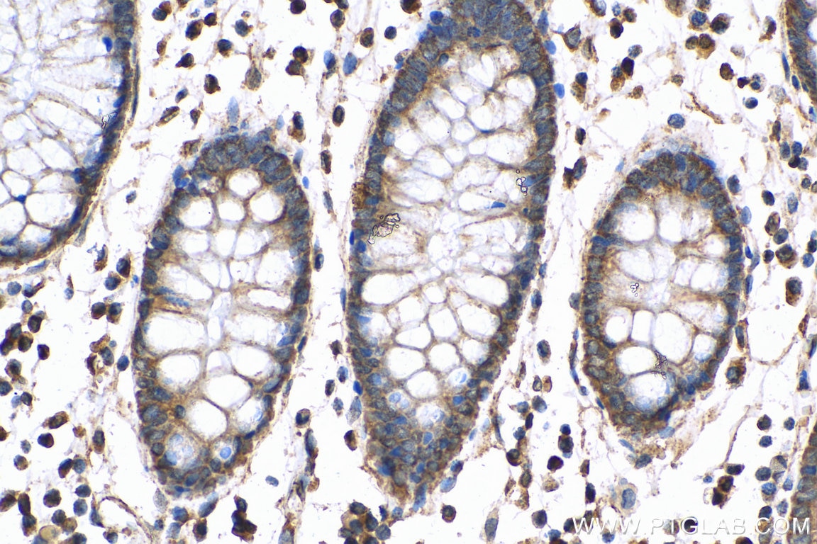 Immunohistochemistry (IHC) staining of human colon cancer tissue using ANGPTL2 Polyclonal antibody (12316-1-AP)