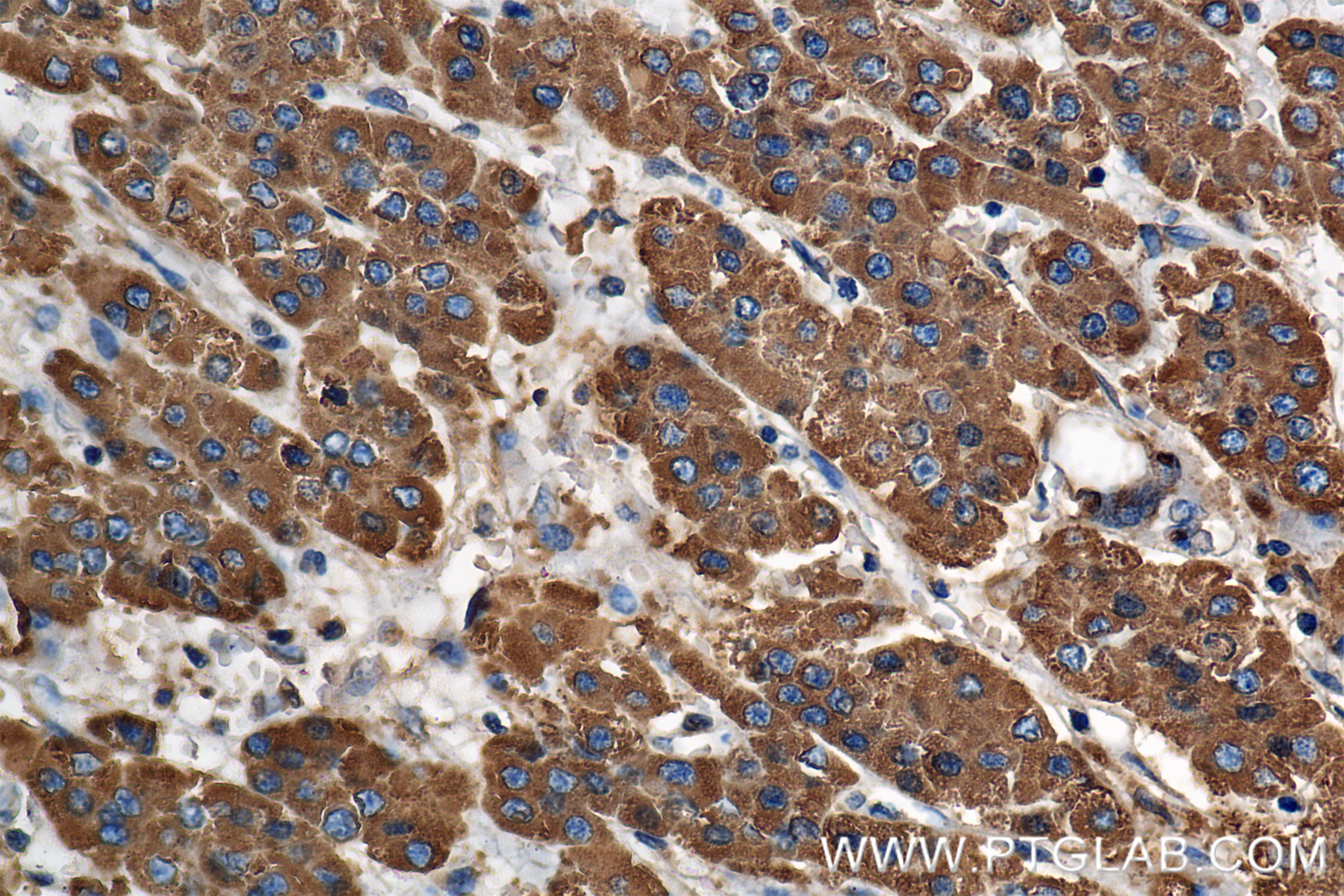 Immunohistochemistry (IHC) staining of human hepatocellular cancer using ANGPTL3 Recombinant antibody (86193-1-RR)