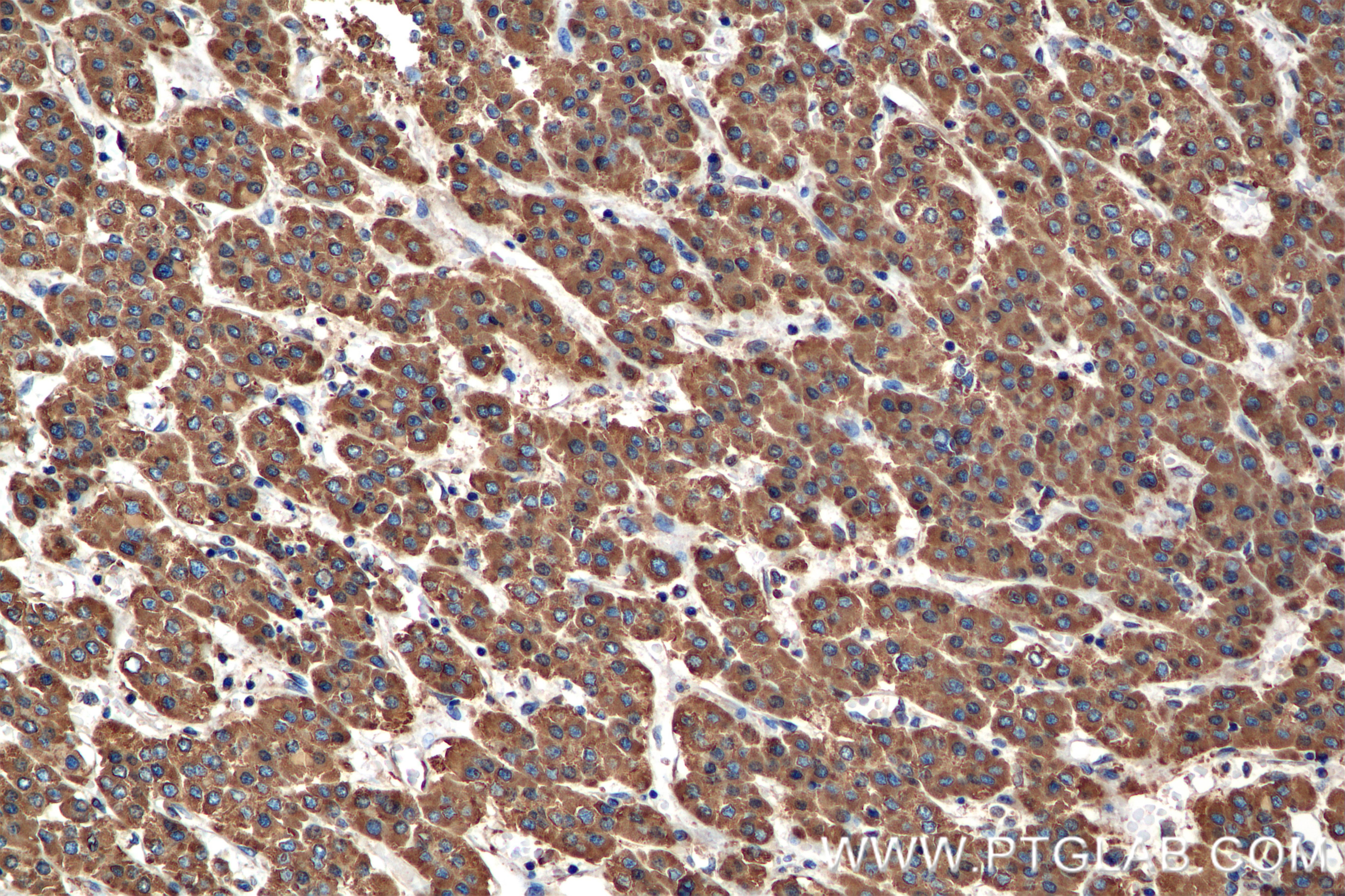 Immunohistochemistry (IHC) staining of human hepatocellular cancer using ANGPTL3 Recombinant antibody (86193-1-RR)