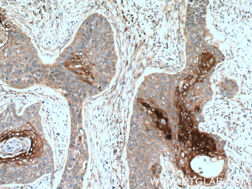 Immunohistochemistry (IHC) staining of human oesophagus cancer tissue using ANGPTL4 Polyclonal antibody (18374-1-AP)