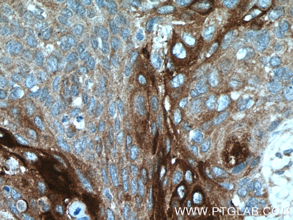 Immunohistochemistry (IHC) staining of human oesophagus cancer tissue using ANGPTL4 Polyclonal antibody (18374-1-AP)