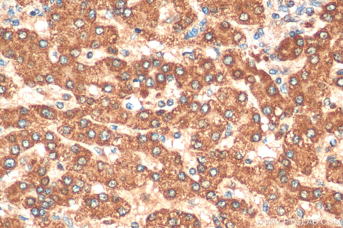 Immunohistochemistry (IHC) staining of human liver cancer tissue using ANGPTL7 Polyclonal antibody (10396-1-AP)
