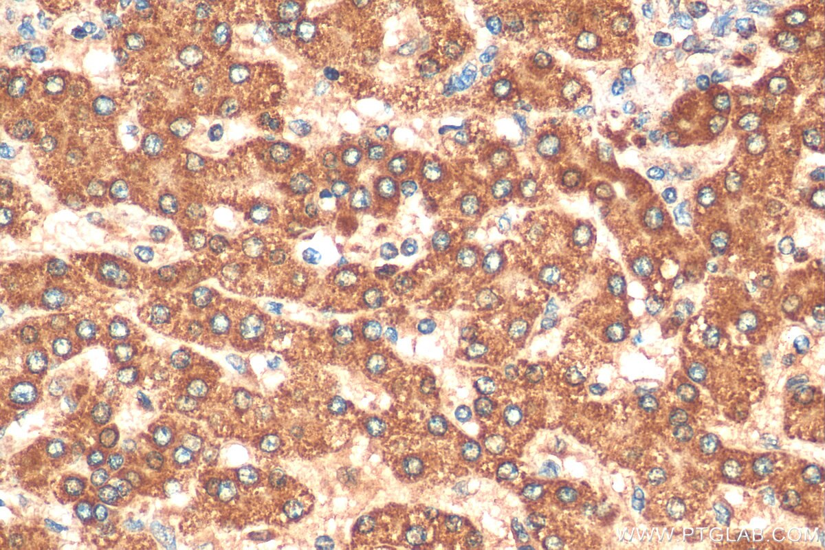 Immunohistochemistry (IHC) staining of human liver cancer tissue using ANGPTL7 Polyclonal antibody (10396-1-AP)