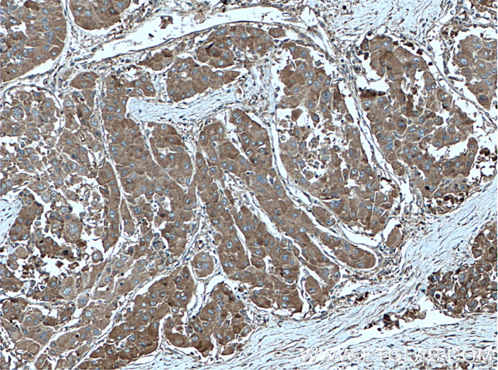 Immunohistochemistry (IHC) staining of human liver cancer tissue using ANGPTL8/Betatrophin Monoclonal antibody (66641-1-Ig)