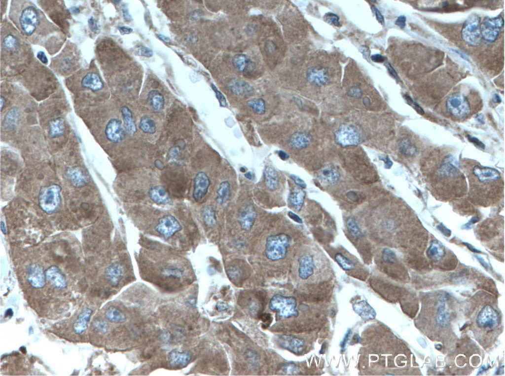 Immunohistochemistry (IHC) staining of human liver cancer tissue using ANGPTL8/Betatrophin Monoclonal antibody (66641-1-Ig)