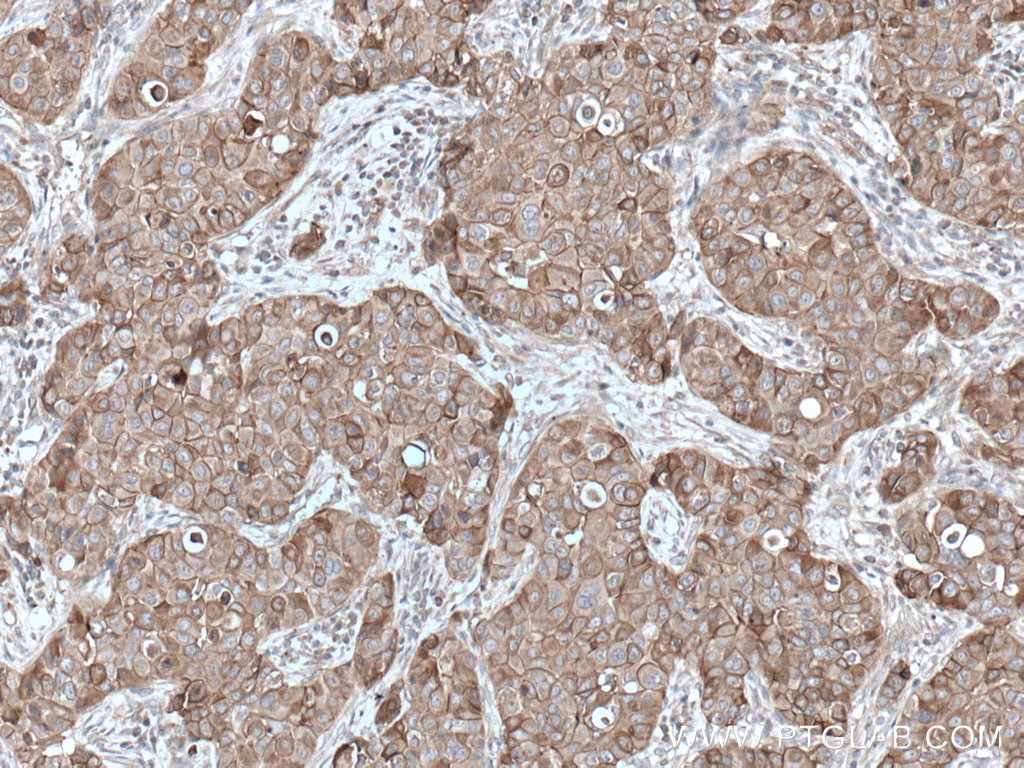 Immunohistochemistry (IHC) staining of human breast cancer tissue using ANK3 Polyclonal antibody (27980-1-AP)
