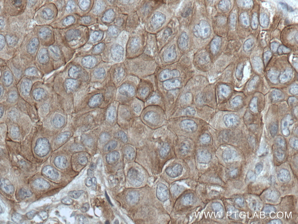 Immunohistochemistry (IHC) staining of human breast cancer tissue using ANK3 Polyclonal antibody (27980-1-AP)