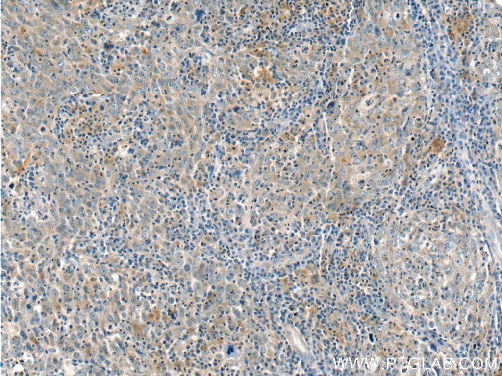 Immunohistochemistry (IHC) staining of human breast cancer tissue using ANKLE1 Polyclonal antibody (24080-1-AP)