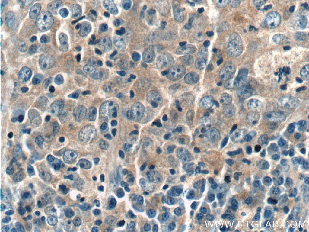 Immunohistochemistry (IHC) staining of human breast cancer tissue using ANKLE1 Polyclonal antibody (24080-1-AP)