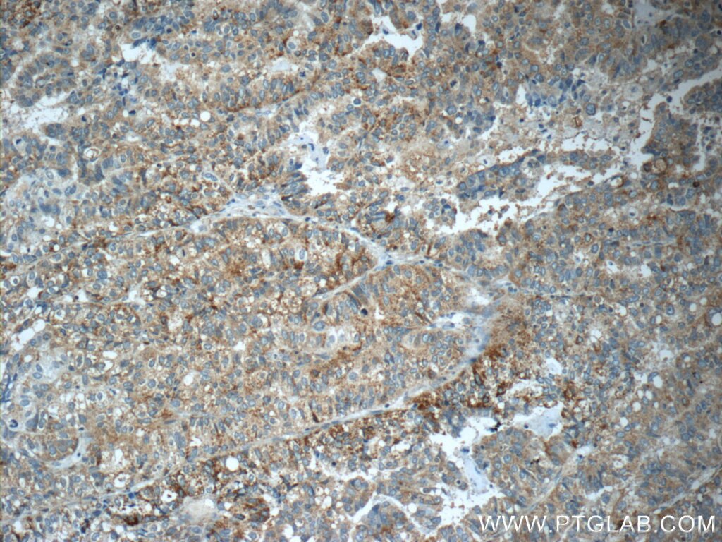 Immunohistochemistry (IHC) staining of human breast cancer tissue using ANKRD13D Polyclonal antibody (21100-1-AP)