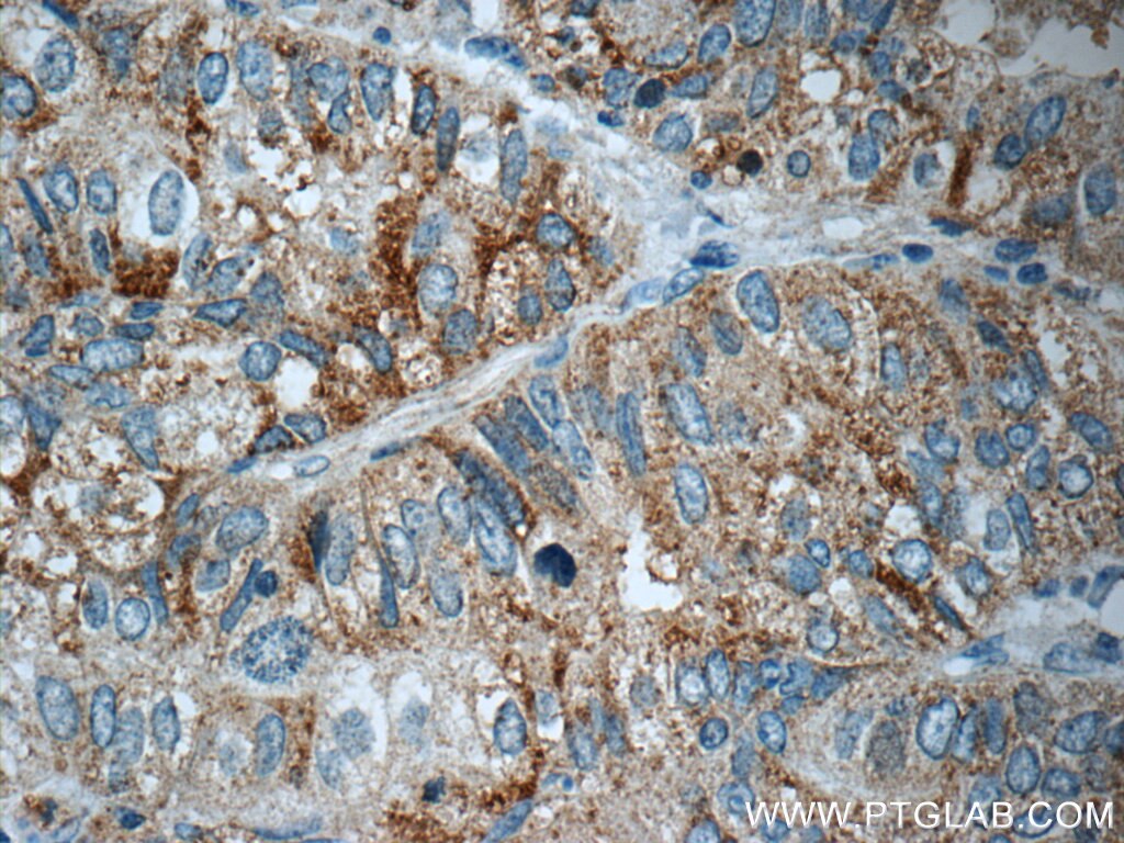 Immunohistochemistry (IHC) staining of human breast cancer tissue using ANKRD13D Polyclonal antibody (21100-1-AP)