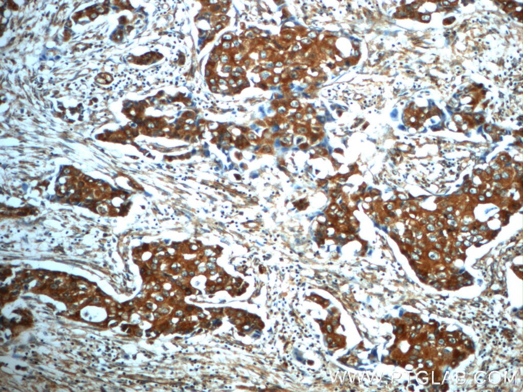Immunohistochemistry (IHC) staining of human breast cancer tissue using ANKRD26 Polyclonal antibody (20035-1-AP)
