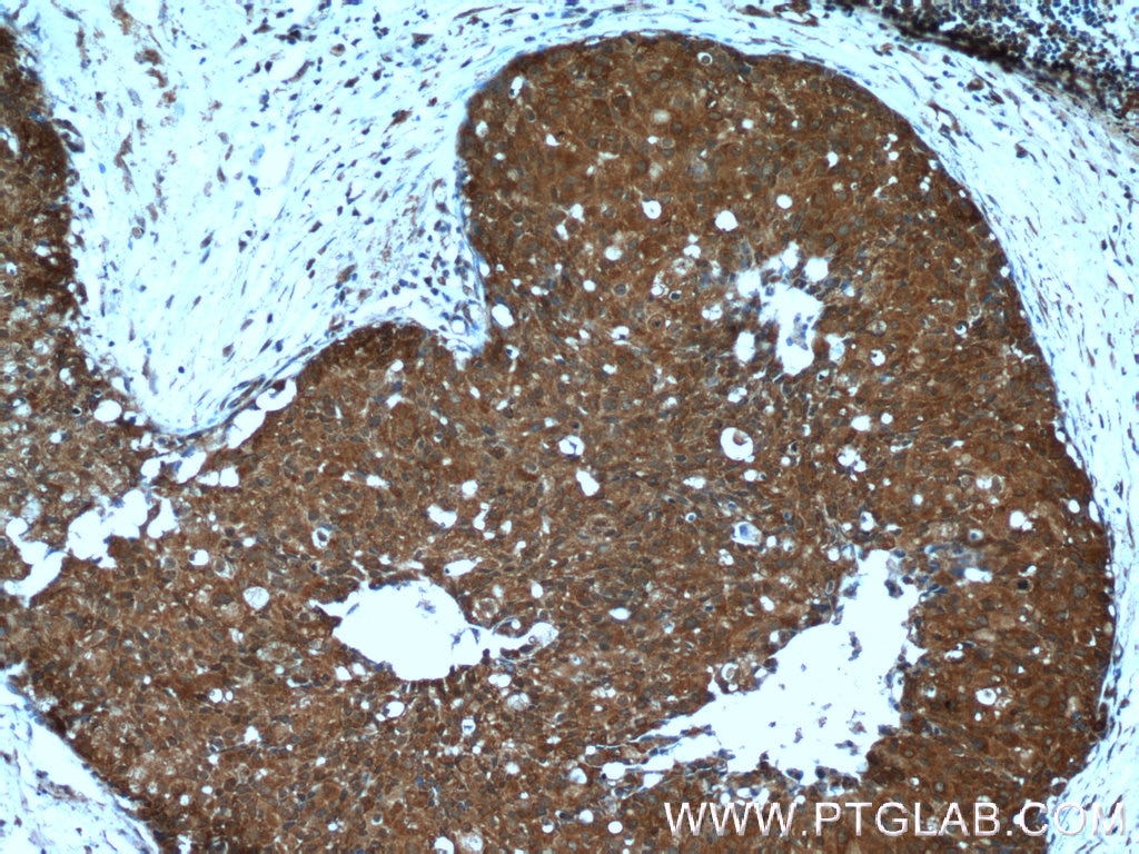 Immunohistochemistry (IHC) staining of human breast cancer tissue using ANKRD27 Polyclonal antibody (24034-1-AP)