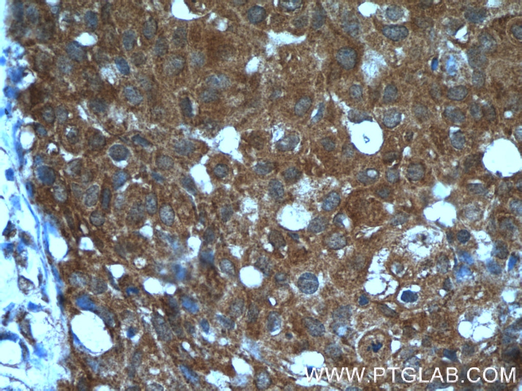Immunohistochemistry (IHC) staining of human breast cancer tissue using ANKRD27 Polyclonal antibody (24034-1-AP)