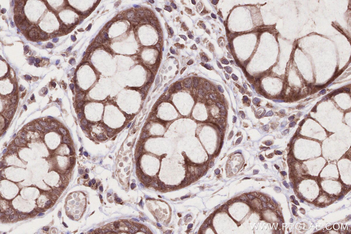IHC staining of human rectal cancer using 24283-1-AP Immunohistochemistry (IHC) staining of human rectal cancer tissue using ANKRD53 Polyclonal antibody (24283-1-AP)