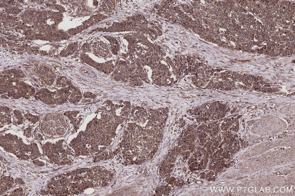 Immunohistochemistry (IHC) staining of human stomach cancer tissue using ANKRD54 Polyclonal antibody (25738-1-AP)