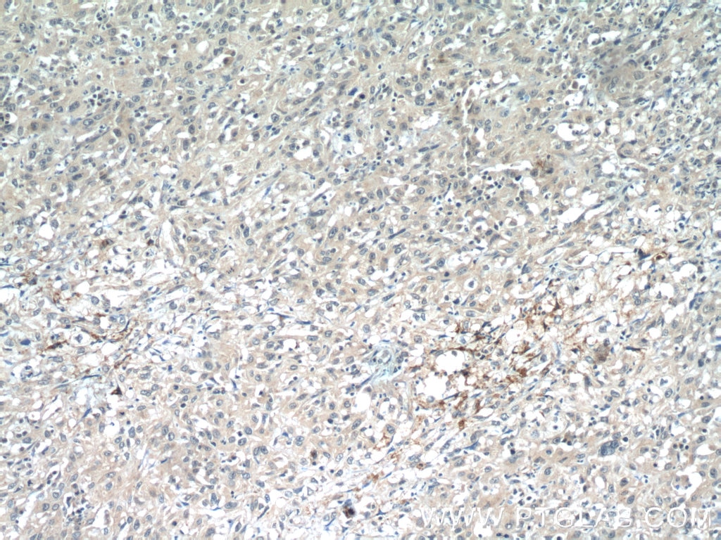 IHC staining of human cervical cancer using 24203-1-AP
