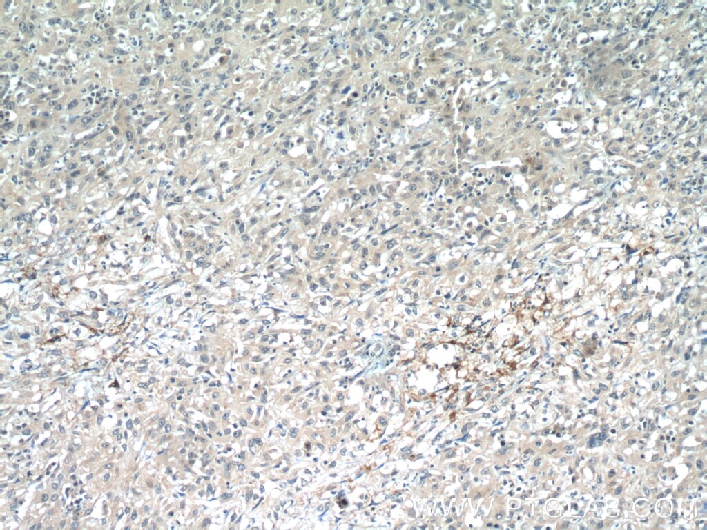 Immunohistochemistry (IHC) staining of human cervical cancer tissue using ANKRD55 Polyclonal antibody (24203-1-AP)
