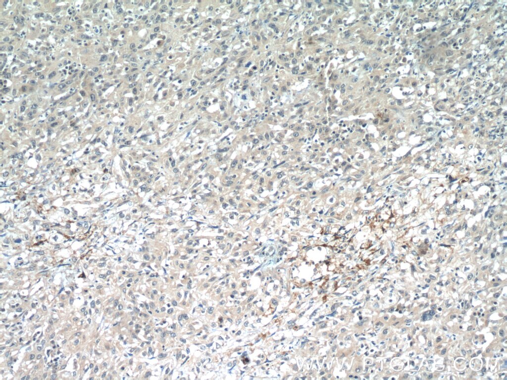 Immunohistochemistry (IHC) staining of human cervical cancer tissue using ANKRD55 Polyclonal antibody (24203-1-AP)