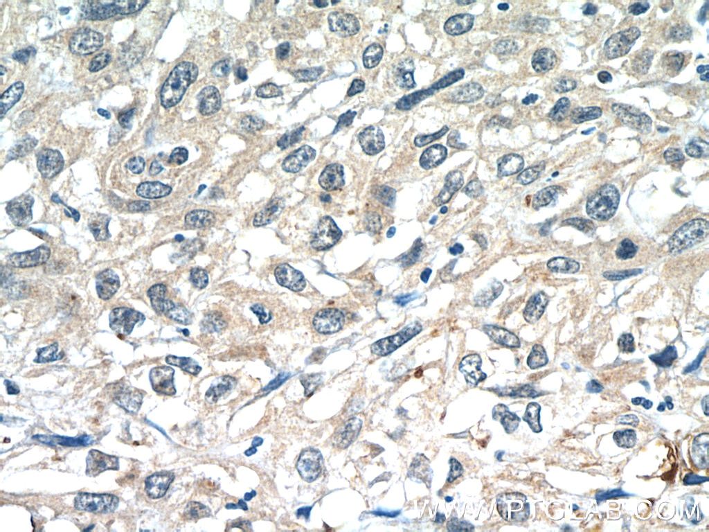 Immunohistochemistry (IHC) staining of human cervical cancer tissue using ANKRD55 Polyclonal antibody (24203-1-AP)