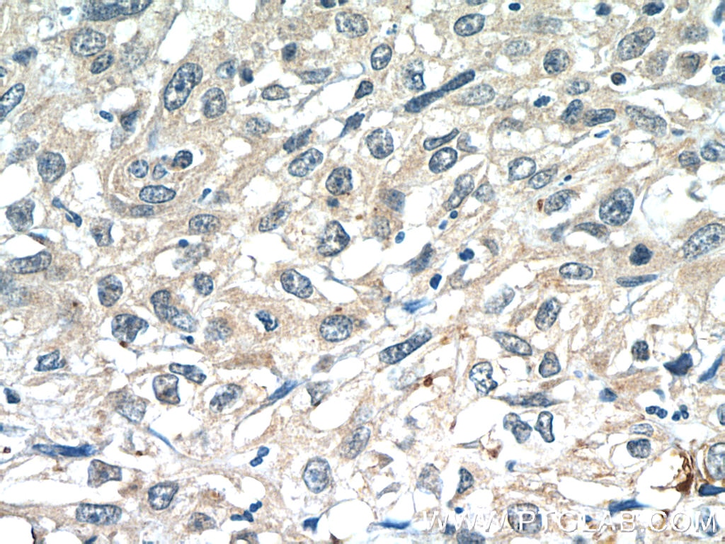 IHC staining of human cervical cancer using 24203-1-AP