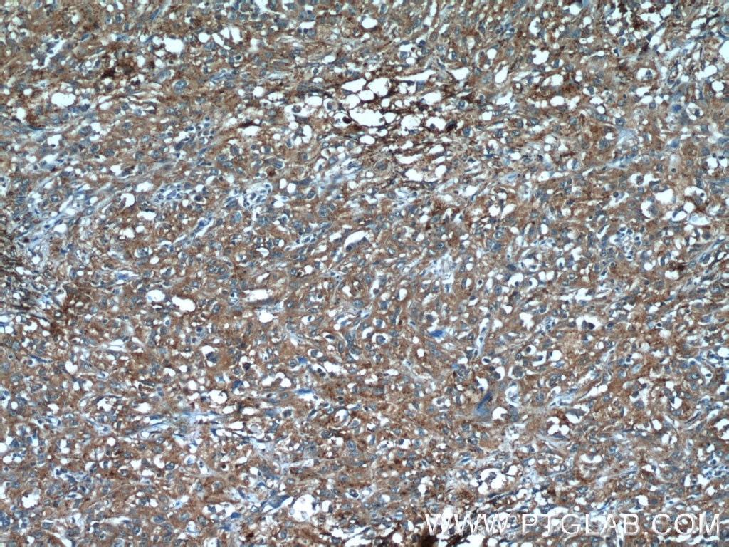 Immunohistochemistry (IHC) staining of human cervical cancer tissue using ANKRD57 Polyclonal antibody (24033-1-AP)