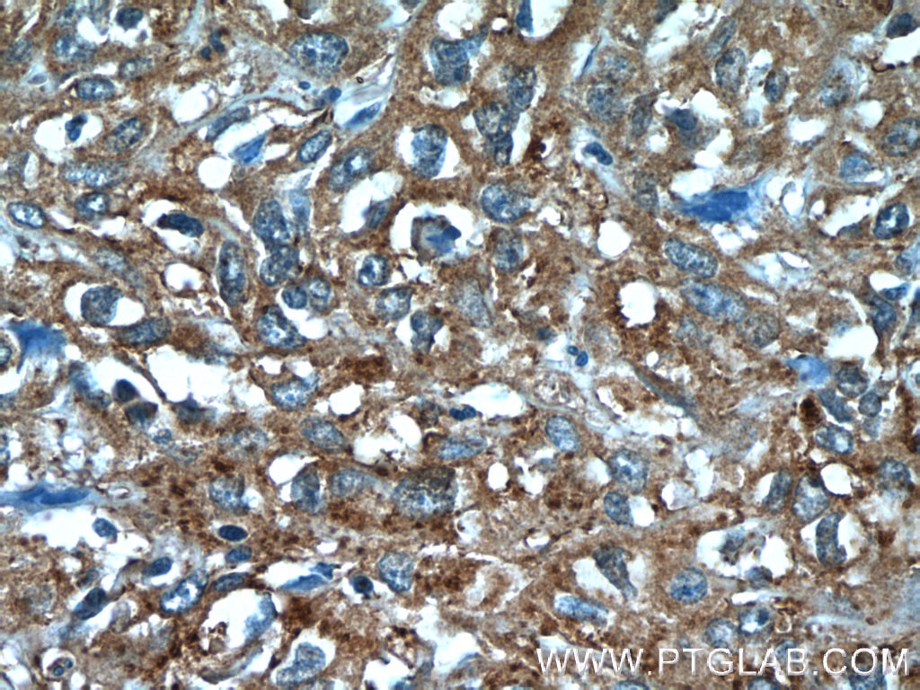 Immunohistochemistry (IHC) staining of human cervical cancer tissue using ANKRD57 Polyclonal antibody (24033-1-AP)