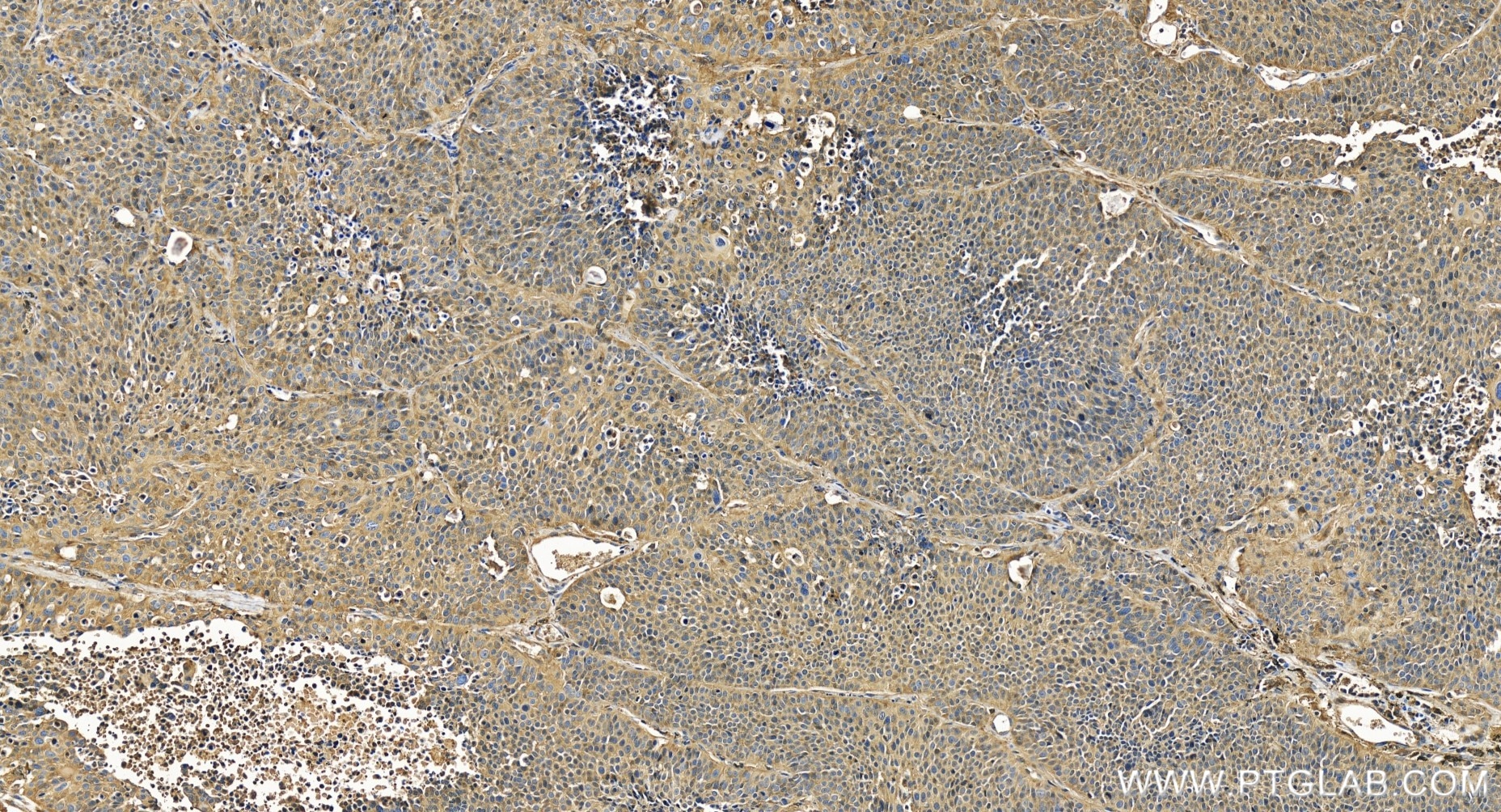 Immunohistochemistry (IHC) staining of human lung cancer tissue using ANKRD6 Recombinant antibody (84210-4-RR)